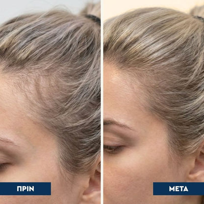 Rootical - Serum κατά της Τριχόπτωσης