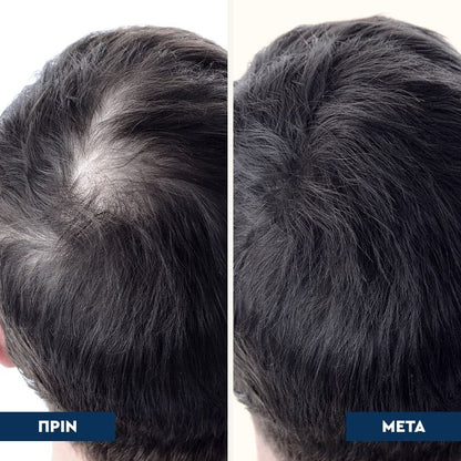 Rootical - Serum κατά της Τριχόπτωσης