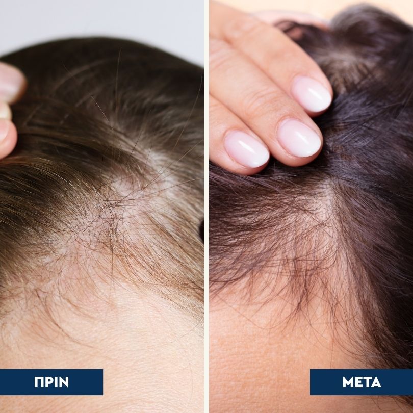 Rootical - Serum κατά της Τριχόπτωσης